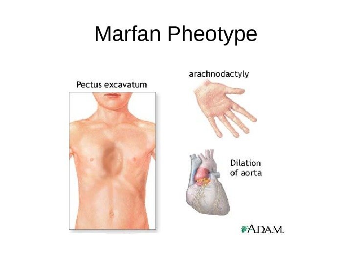 Marfan Pheotype 
