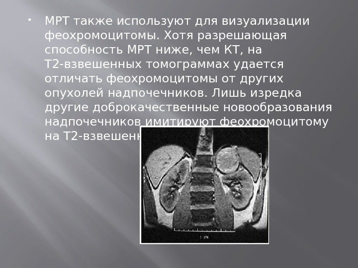  МРТ также используют для визуализации феохромоцитомы. Хотя разрешающая способность МРТ ниже, чем КТ,