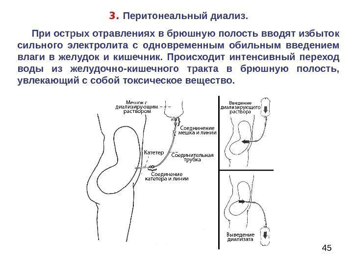 453.  Перитонеальный диализ.  При острых отравлениях в брюшную полость вводят избыток сильного