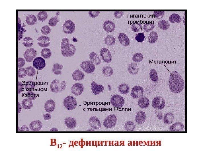 В 12 - дефицитная анемия 