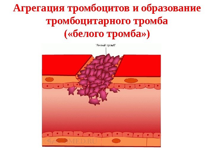 Агрегация тромбоцитов и образование тромбоцитарного тромба ( «белого тромба» ) 