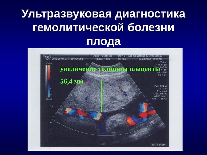 Ультразвуковая диагностика гемолитической болезни плода увеличение толщины плаценты 56, 4 мм 