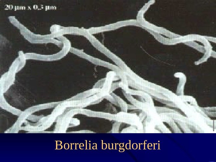 Borrelia burgdorferi 