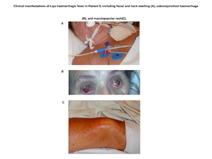   Clinical manifestations of Lujo haemorrhagic fever in Patient 5, including facial and