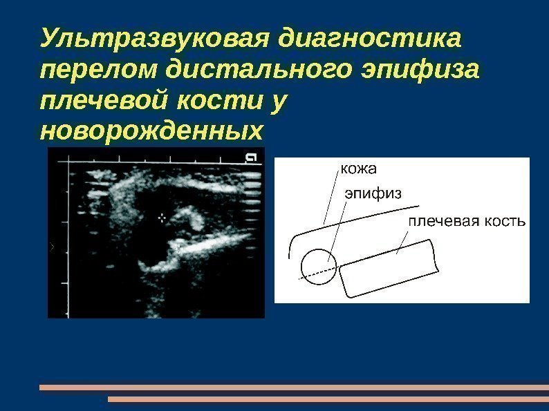 Ультразвуковая диагностика перелом дистального эпифиза плечевой кости у новорожденных 