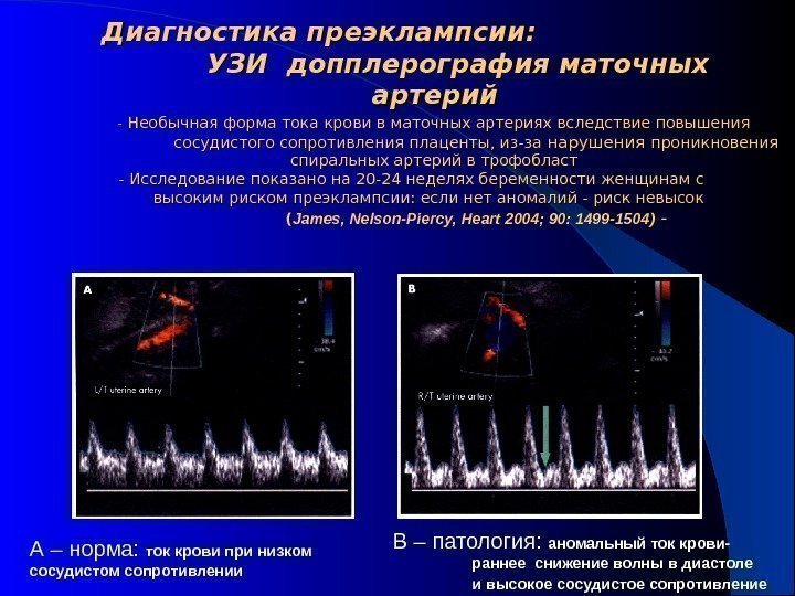 - Необычная форма тока крови в маточных артериях вследствие повышения сосудистого сопротивления плаценты, из-за