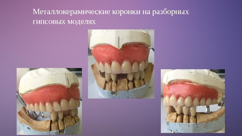 Металлокерамические коронки на разборных гипсовых моделях 