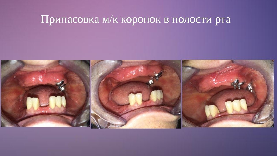 Припасовка м/к коронок в полости рта 