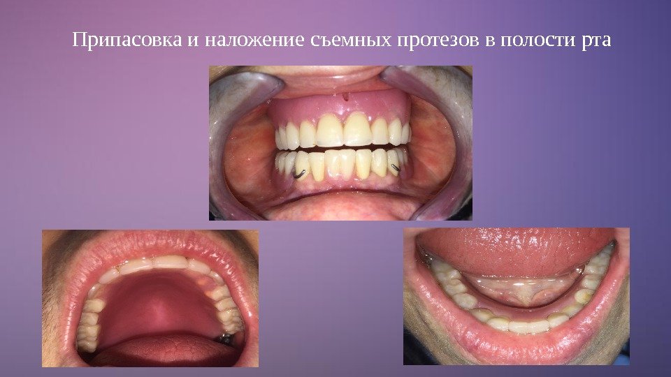 Припасовка и наложение съемных протезов в полости рта 