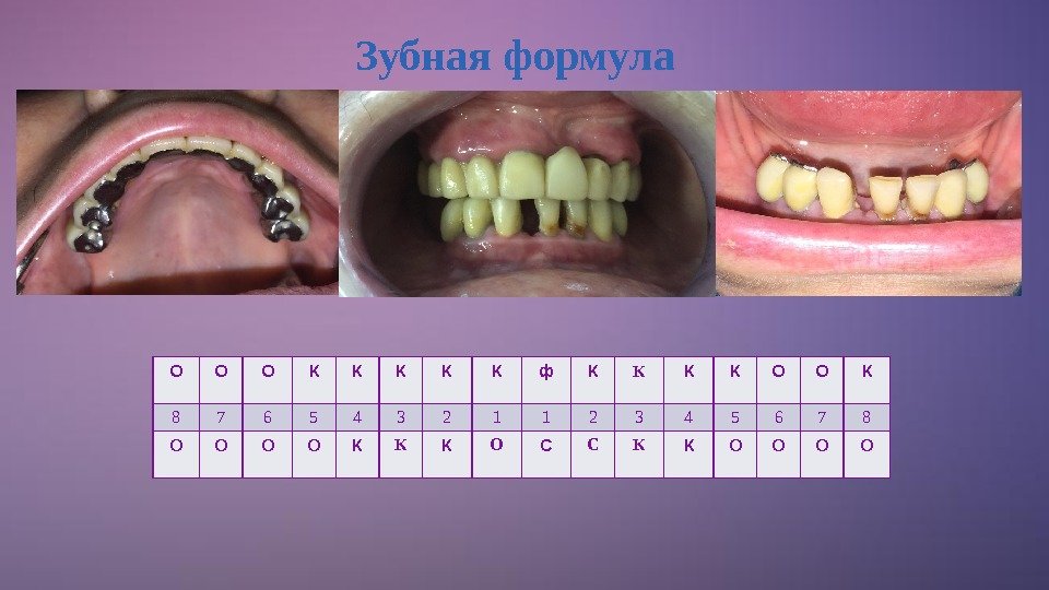 Зубная формула О О О К К К ф К К О О К