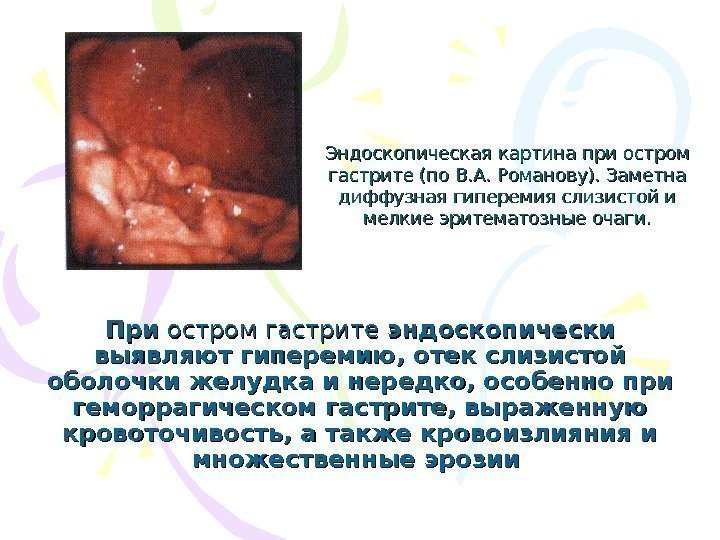   Эндоскопическая картина при остром гастрите (по В. А. Романову). Заметна диффузная гиперемия