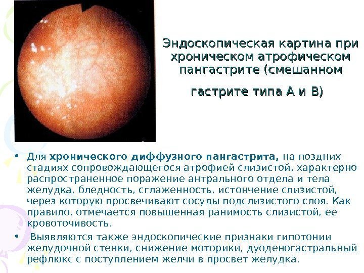   Эндоскопическая картина при хроническом атрофическом пангастрите (смешанном гастрите типа А и В)