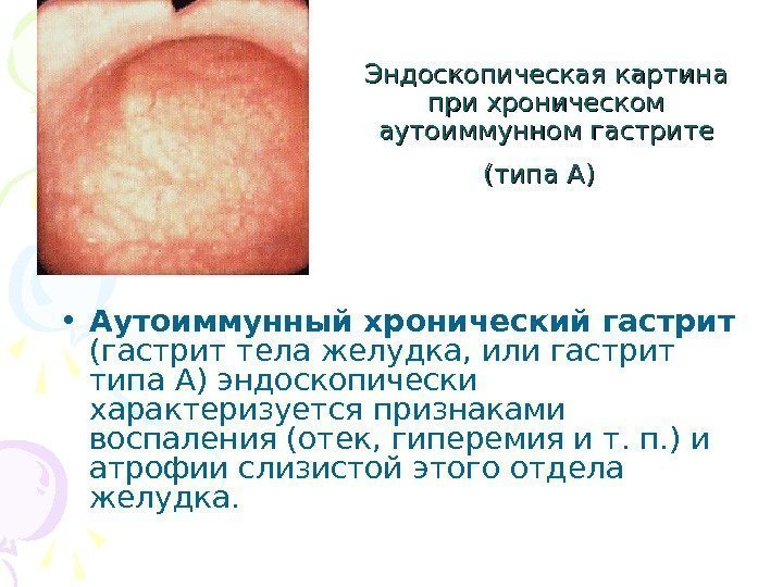   Эндоскопическая картина при хроническом аутоиммунном гастрите (типа А) • Аутоиммунный хронический гастрит
