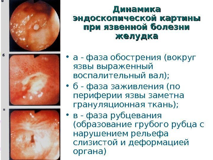   Динамика эндоскопической картины при язвенной болезни желудка • а - фаза обострения