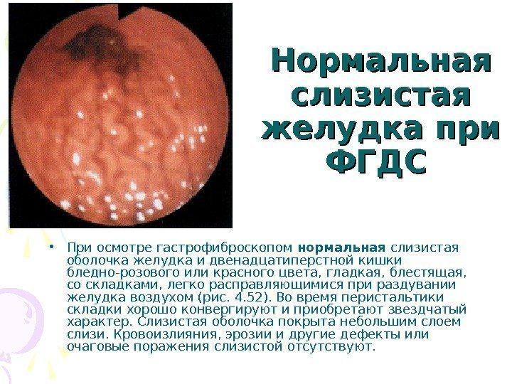   Нормальная слизистая желудка при ФГДС • При осмотре гастрофиброскопом нормальная слизистая оболочка