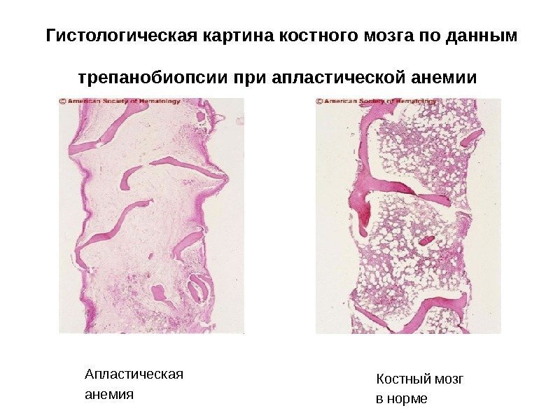 Гистологическая картина костного мозга по данным трепанобиопсии при апластической анемии  Апластическая анемия Костный