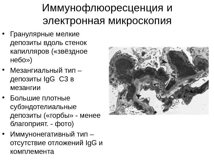   Иммунофлюоресценция и электронная микроскопия • Гранулярные мелкие депозиты вдоль стенок капилляров (