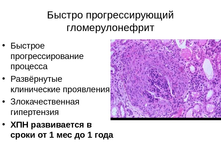   Быстро прогрессирующий гломерулонефрит • Быстрое прогрессирование процесса  • Развёрнутые клинические проявления