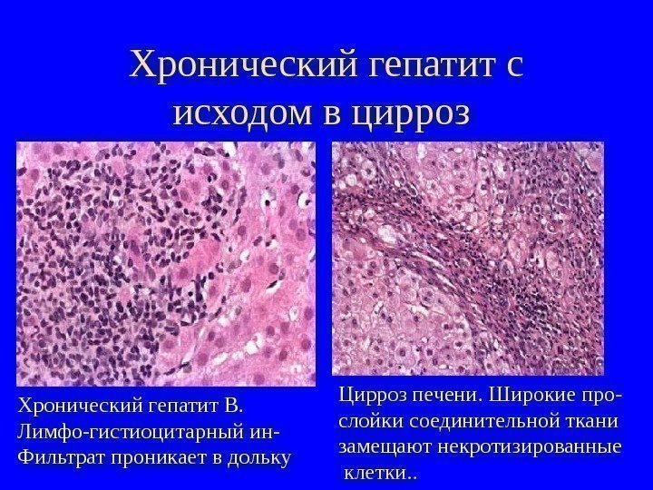   Хронический гепатит с исходом в цирроз Хронический гепатит В. Лимфо-гистиоцитарный ин- Фильтрат