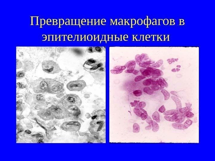   Превращение макрофагов в эпителиоидные клетки 