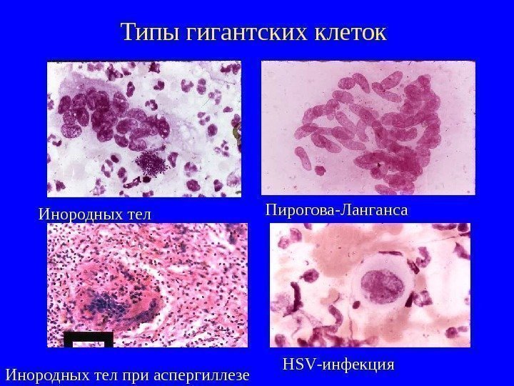   Типы гигантских клеток Инородных тел Пирогова-Ланганса Инородных тел при аспергиллезе HSV -инфекция