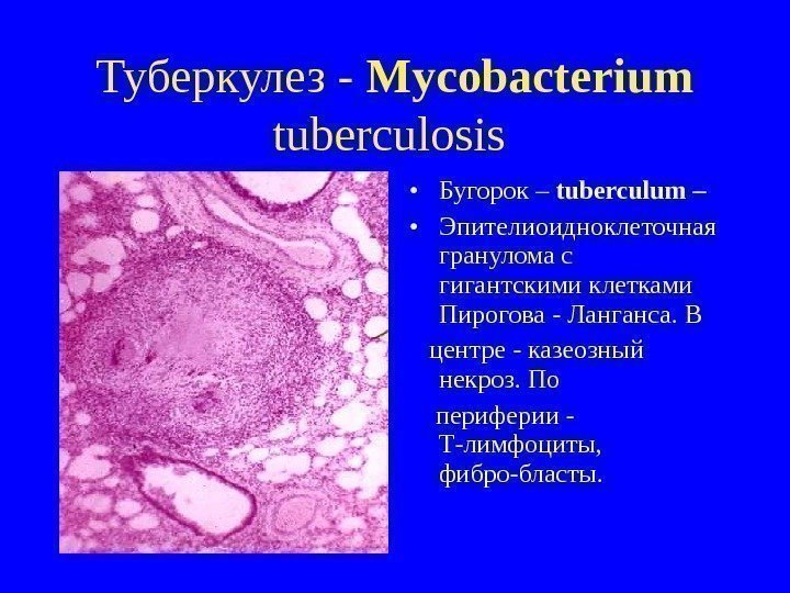   Туберкулез - Mycobacterium tuberculosis  • Бугорок – tuberculum –  •