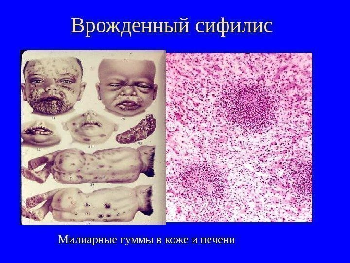  Врожденный сифилис Милиарные гуммы в коже и печени 