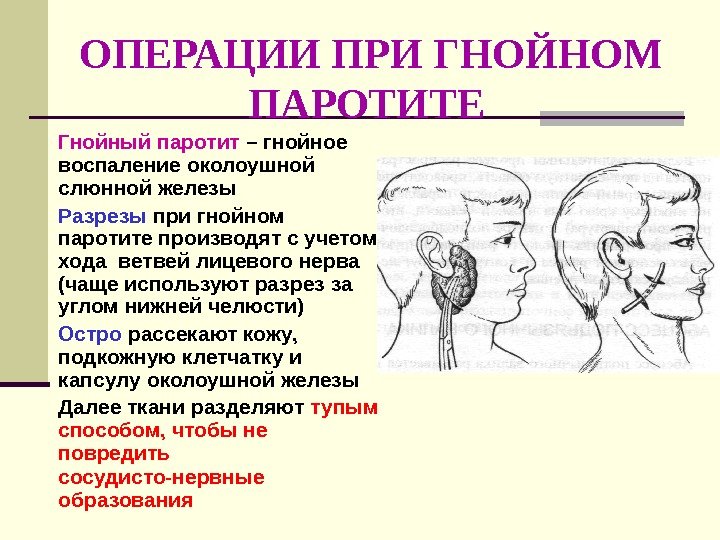   ОПЕРАЦИИ ПРИ ГНОЙНОМ   ПАРОТИТЕ Гнойный паротит – гнойное воспаление околоушной