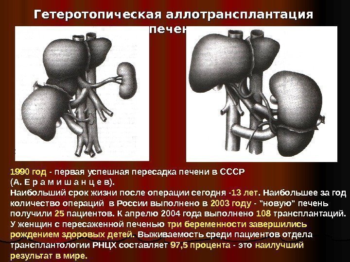   Гетеротопическая аллотрансплантация печени 1990 год - первая успешная пересадка печени в СССР