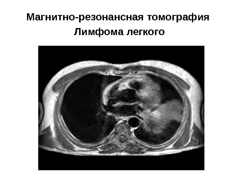 Магнитно-резонансная томография Лимфома легкого 