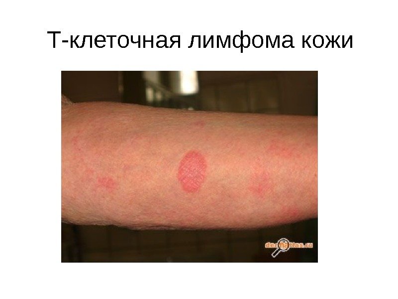 Т-клеточная лимфома кожи 