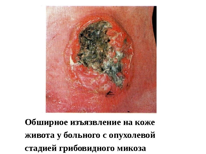 Обширное изъязвление на коже живота у больного с опухолевой стадией грибовидного микоза 