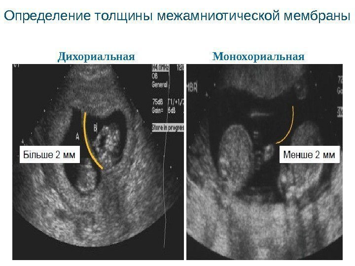 Определение толщины межамниотической мембраны Дихориальная Монохориальная 