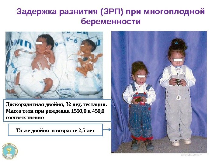 Дискордантная двойня, 32 нед. гестации. Масса тела при рождении 1550, 0 и 450, 0