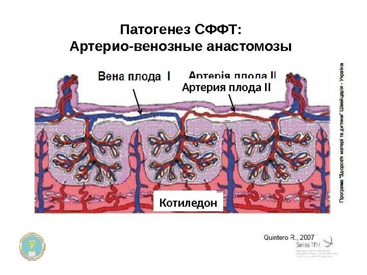 Патогенез СФФТ: Артерио-венозные анастомозы Котиледон Артерия плода ІІ 
