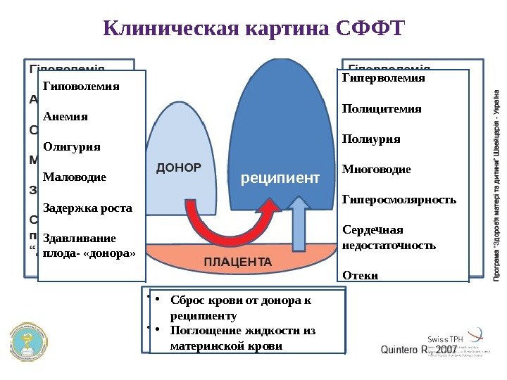 Клиническая картина СФФТ Гиповолемия Анемия Олигурия Маловодие Задержка роста Здавливание плода- «донора» Гиперволемия Полицитемия