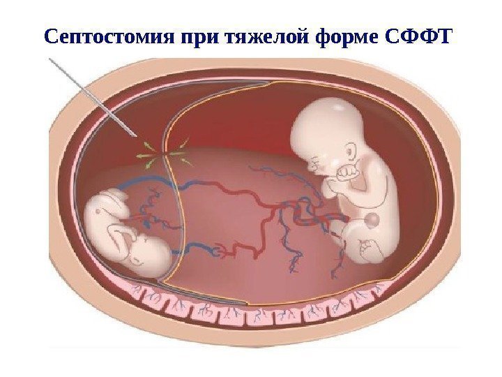 Септостомия при тяжелой форме СФФТ 