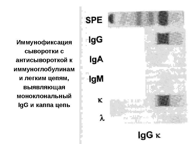 Иммунофиксация сыворотки с антисывороткой к иммуноглобулинам и легким цепям,  выявляющая моноклональный Ig. G