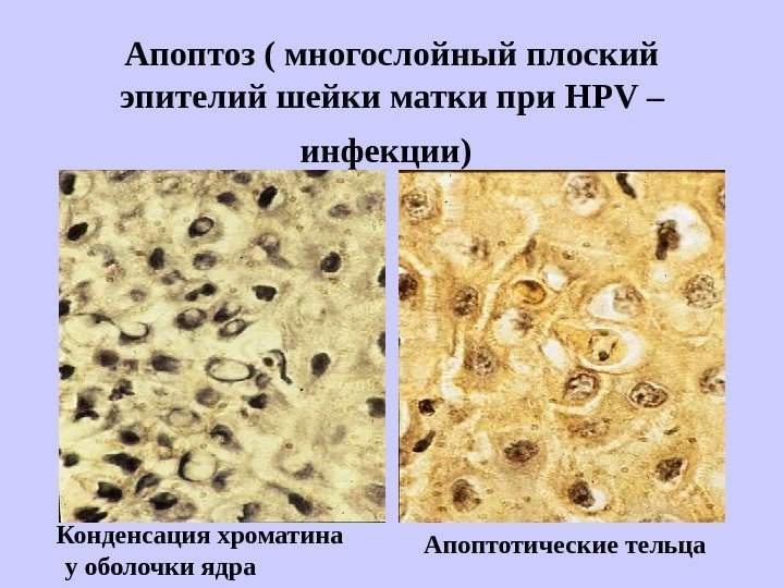   Апоптоз ( многослойный плоский эпителий шейки матки при НР V – инфекции)