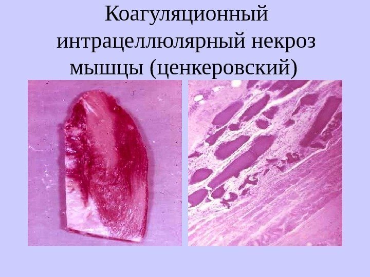   Коагуляционный интрацеллюлярный некроз мышцы (ценкеровский) 