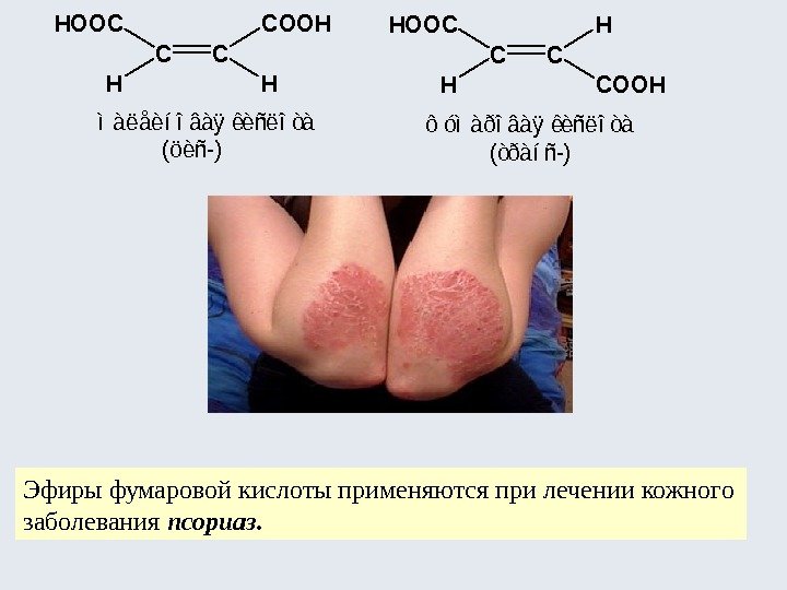 Эфиры фумаровой кислоты применяются при лечении кожного заболевания псориаз. CC HOOC H COOH H