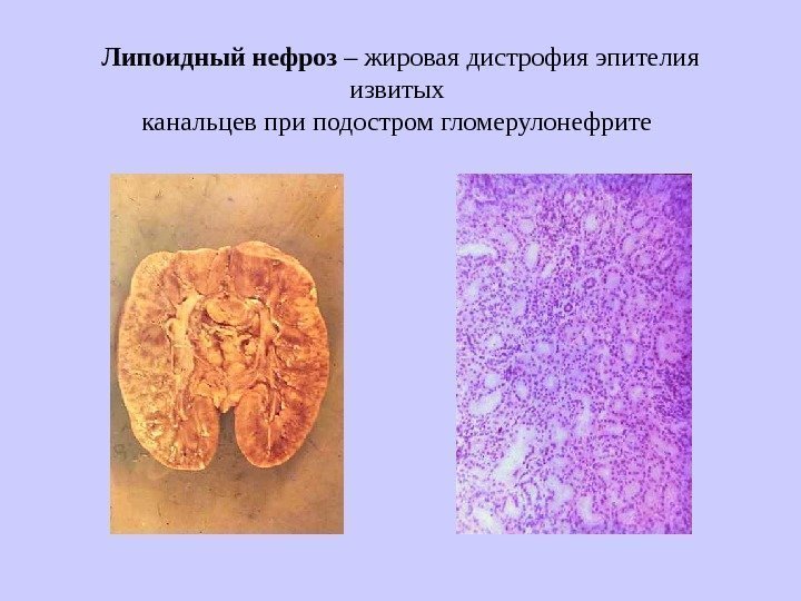   Липоидный нефроз – жировая дистрофия эпителия извитых канальцев при подостром гломерулонефрите 