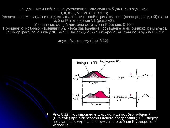 Раздвоение и небольшое увеличение амплитуды зубцов Р в отведениях I, II, a. VL, V