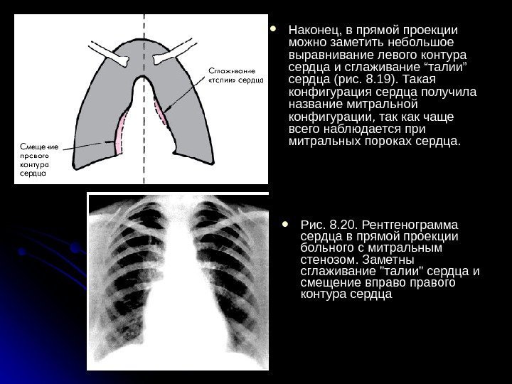  Наконец, в прямой проекции можно заметить небольшое выравнивание левого контура сердца и сглаживание