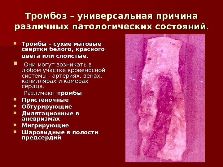   Тромбоз – универсальная причина различных патологических состояний. .  Тромбы – сухие