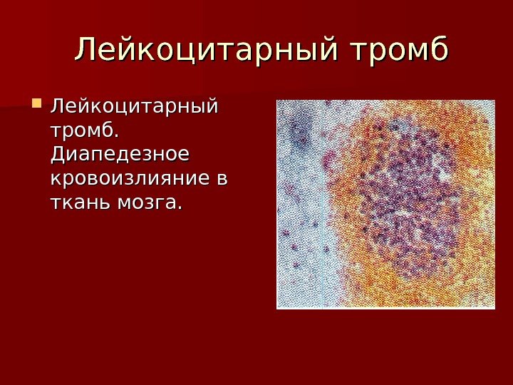  Лейкоцитарный тромб.  Диапедезное кровоизлияние в ткань мозга. 