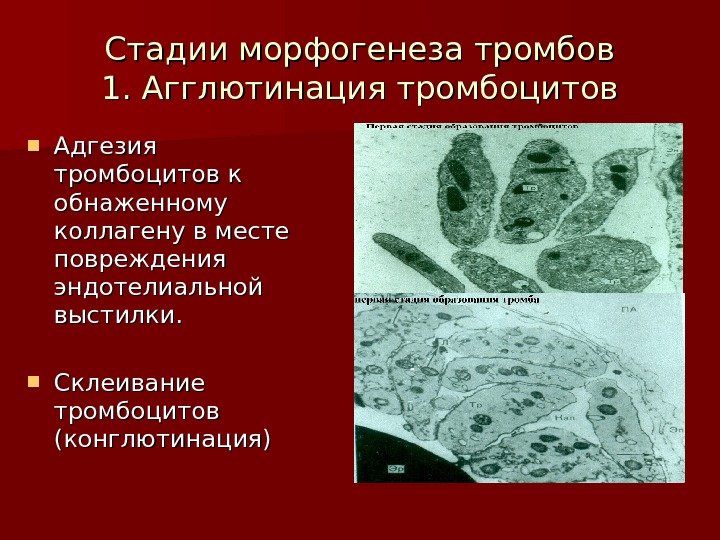  Стадии морфогенеза тромбов 1. Агглютинация тромбоцитов Адгезия тромбоцитов к обнаженному коллагену в