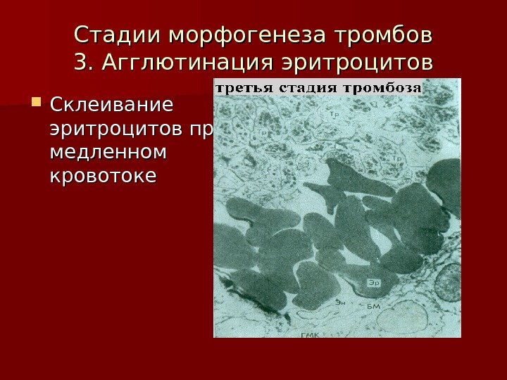   Стадии морфогенеза тромбов 3. Агглютинация эритроцитов Склеивание эритроцитов при медленном кровотоке 