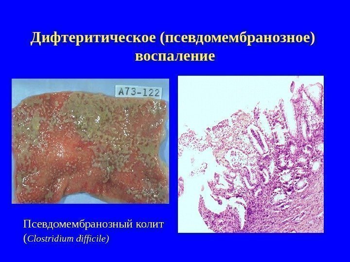   Дифтеритическое (псевдомембранозное)  воспаление Псевдомембранозный колит ( Clostridium difficile) 
