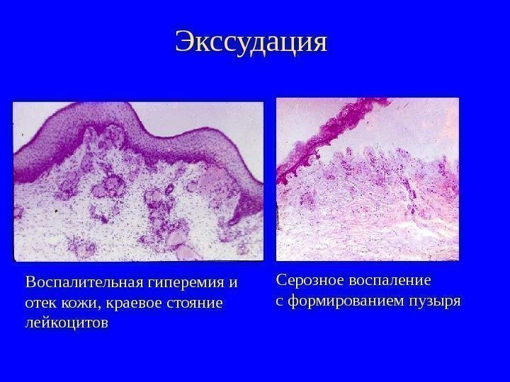   Экссудация Воспалительная гиперемия и отек кожи, краевое стояние лейкоцитов Серозное воспаление с